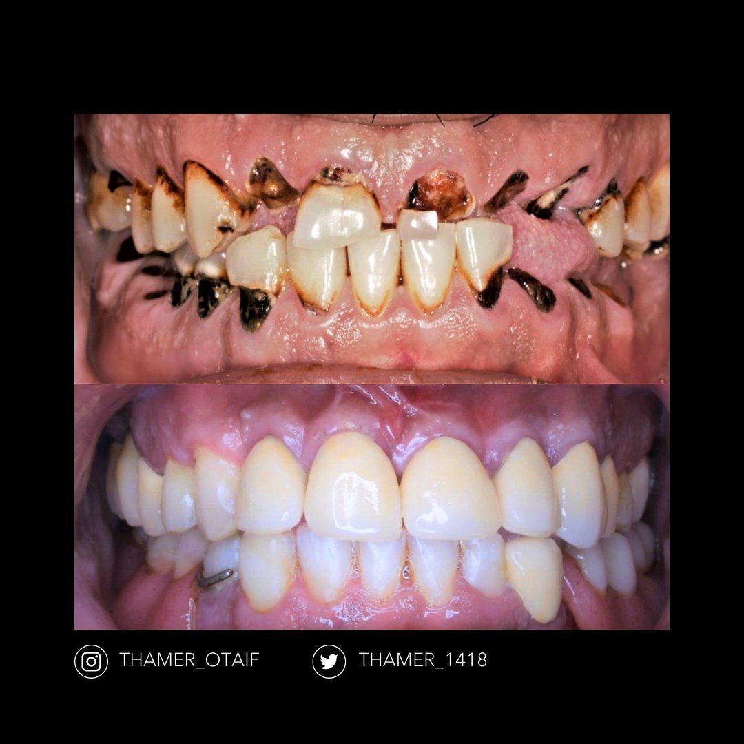 sanoonvip's tweet photo. ⭐🦷
مشاركة د.ثامر عطيف من جامعة جازان 👏
TW: @Thamer_1418
 ❤️ 💬  🔁 
#طب_الاسنان https://t.co/EFeTXPHpUY
