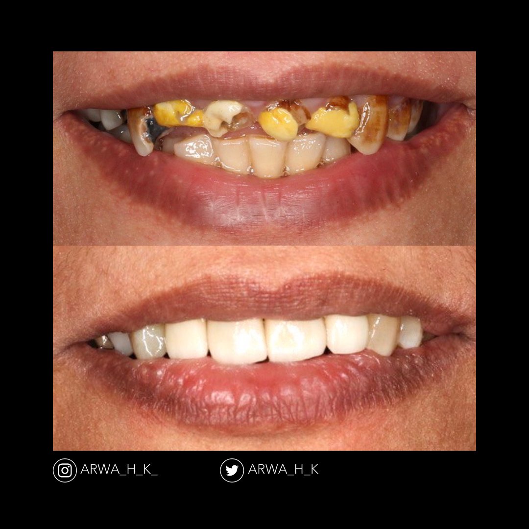 sanoonvip's tweet photo. ⭐🦷
مشاركة د.أروى خواجي من جامعة جازان👏
TW : @Arwa_h_k
❤️ 💬  🔁 
#طب_الاسنان https://t.co/aWx22mbRBP