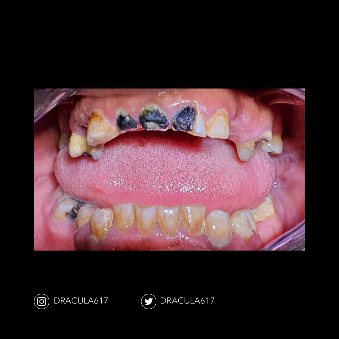 sanoonvip's tweet photo. ⭐🦷
مشاركة د.عمار الناصر من جامعة الملك فيصل👏
TW : @dracula617
 ❤️ 💬  🔁 
#طب_الاسنان https://t.co/qdhpkqVa0O