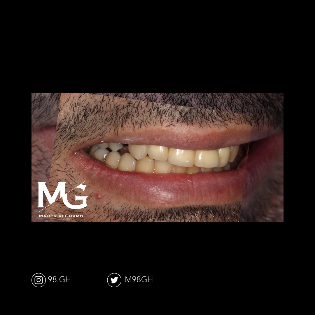 sanoonvip's tweet photo. ⭐🦷
مشاركة د.ماهر الغامدي من جامعة الامام عبدالرحمن بن فيصل 👏
TW : @m98gh
 ❤️ 💬  🔁 
#طب_الاسنان https://t.co/Z7y8w2LpWF