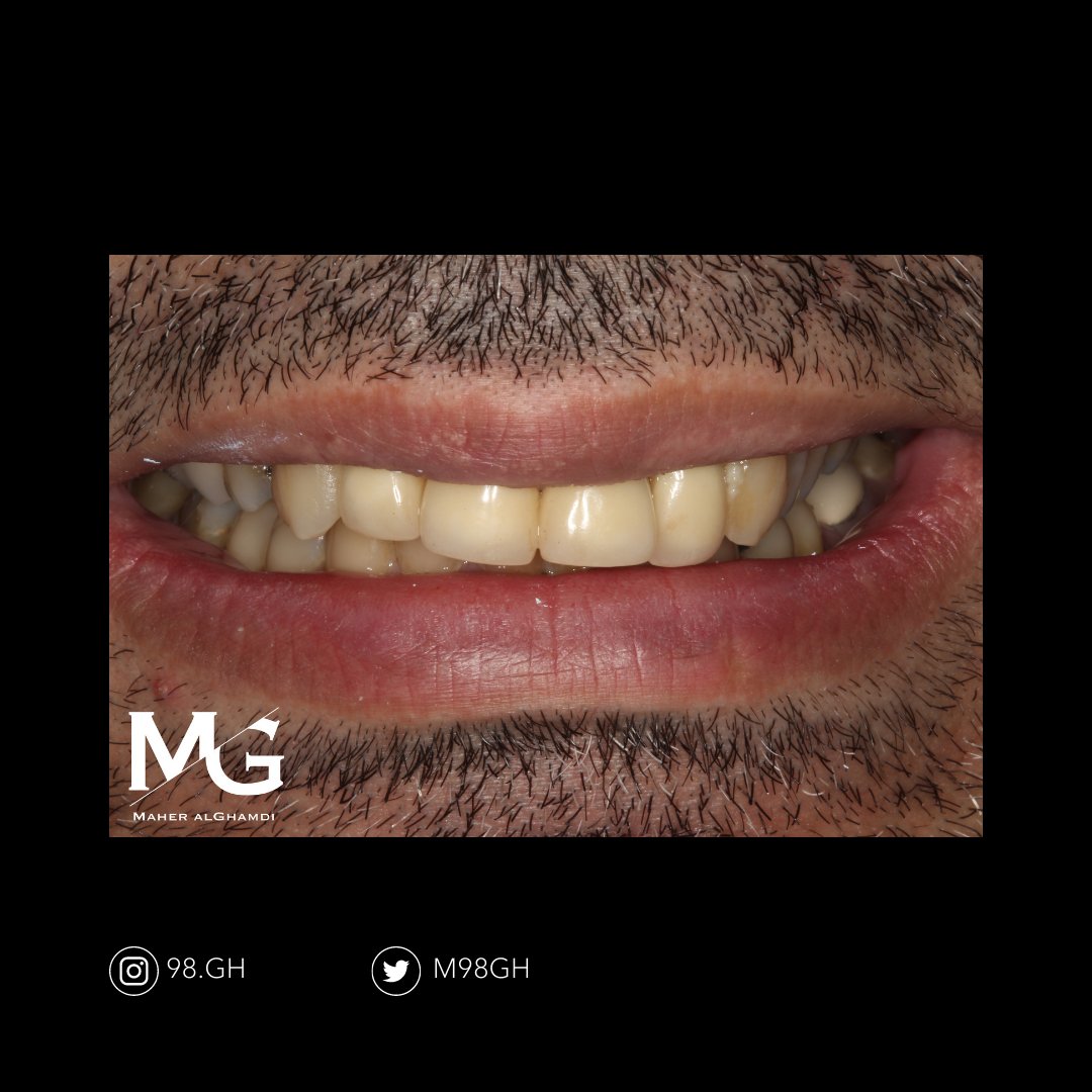 sanoonvip's tweet photo. ⭐🦷
مشاركة د.ماهر الغامدي من جامعة الامام عبدالرحمن بن فيصل 👏
TW : @m98gh
 ❤️ 💬  🔁 
#طب_الاسنان https://t.co/Z7y8w2LpWF