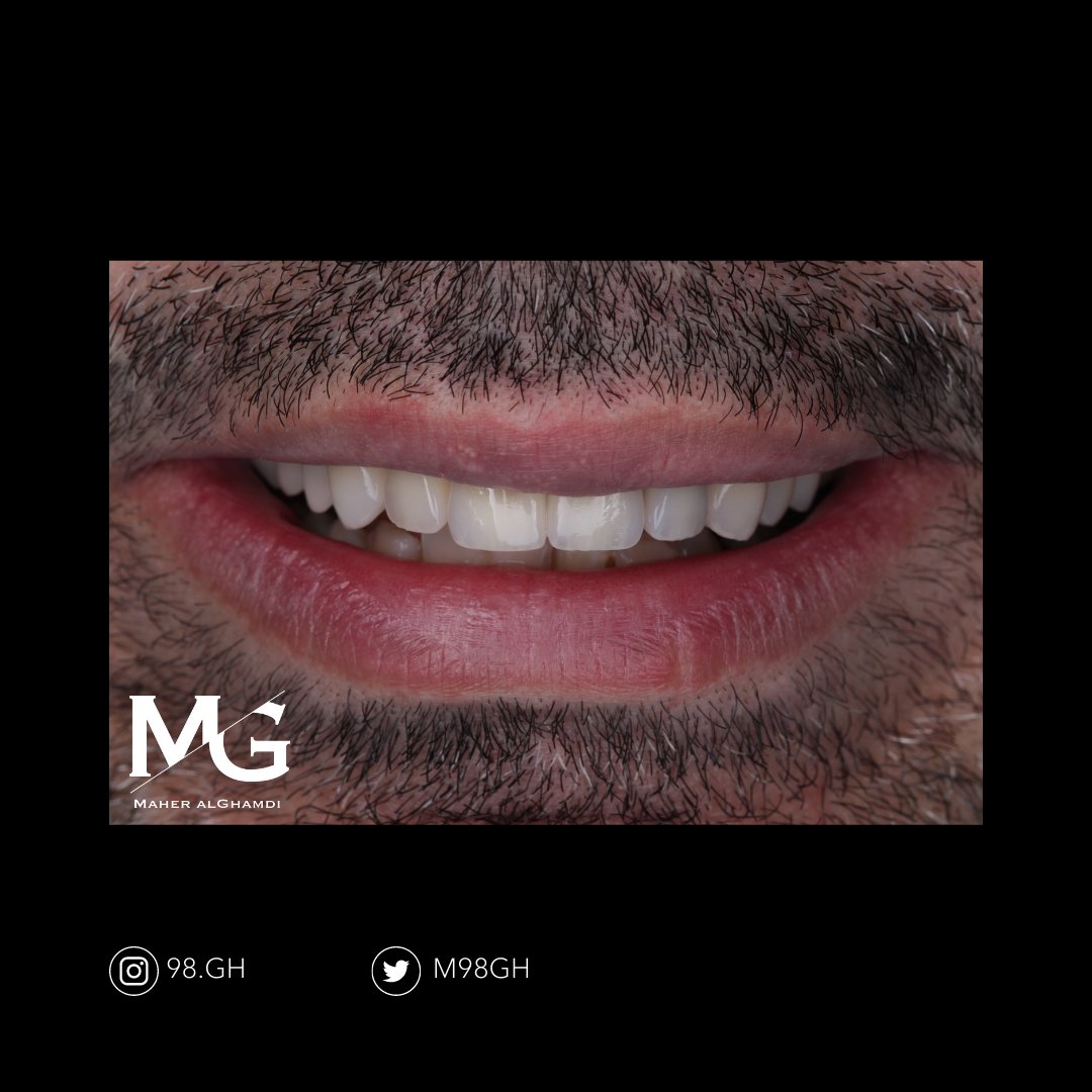 sanoonvip's tweet photo. ⭐🦷
مشاركة د.ماهر الغامدي من جامعة الامام عبدالرحمن بن فيصل 👏
TW : @m98gh
 ❤️ 💬  🔁 
#طب_الاسنان https://t.co/Z7y8w2LpWF