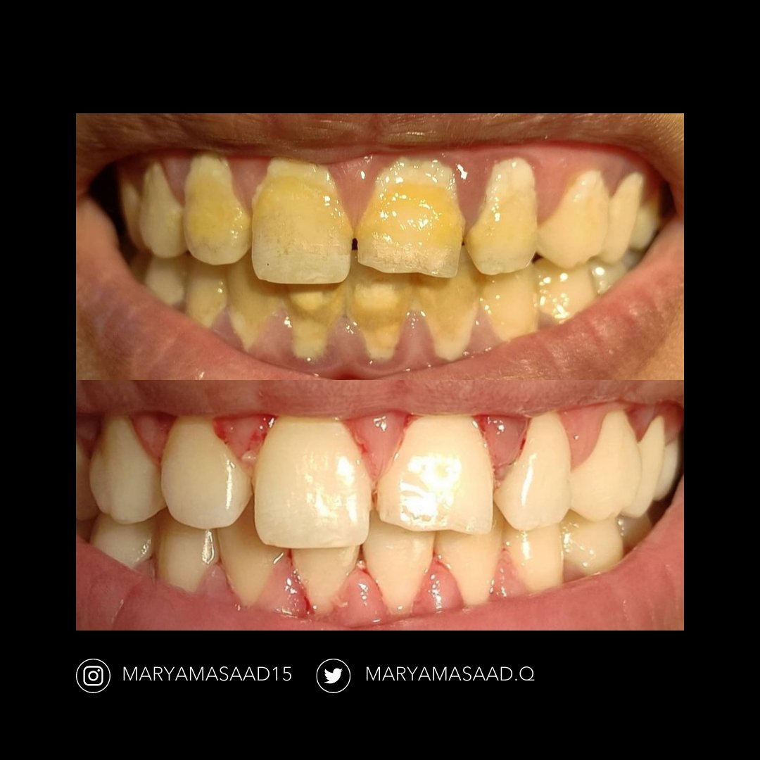 sanoonvip's tweet photo. ⭐🦷
مشاركة د. مريم أسعد من جامعة اوروك بالعراق👏 
TW : @Maryamasaad15
❤️ 💬  🔁 
#طب_الاسنان https://t.co/41bbuM8eGM