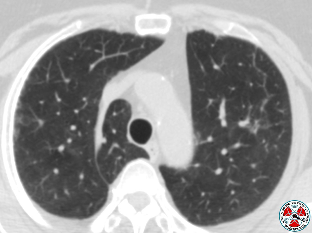 ¿Cuál es tu impresión diagnóstica? #radres #radiology #rx #ctscan