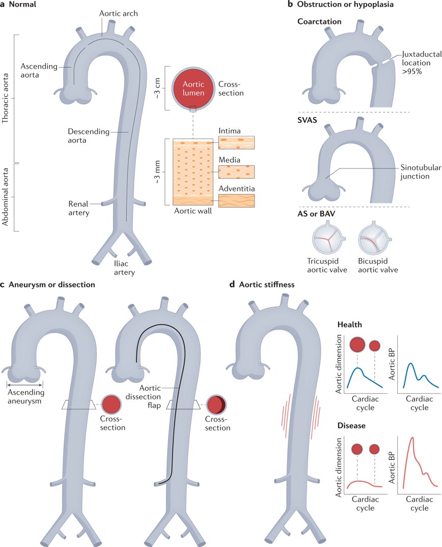 New Review by @MarkELindsay &amp; colleagues on how advances in our biological understanding of thoracic aortic disease can contribute to strategies to prevent and treat aortic disease | rdcu.be/cWkd3
