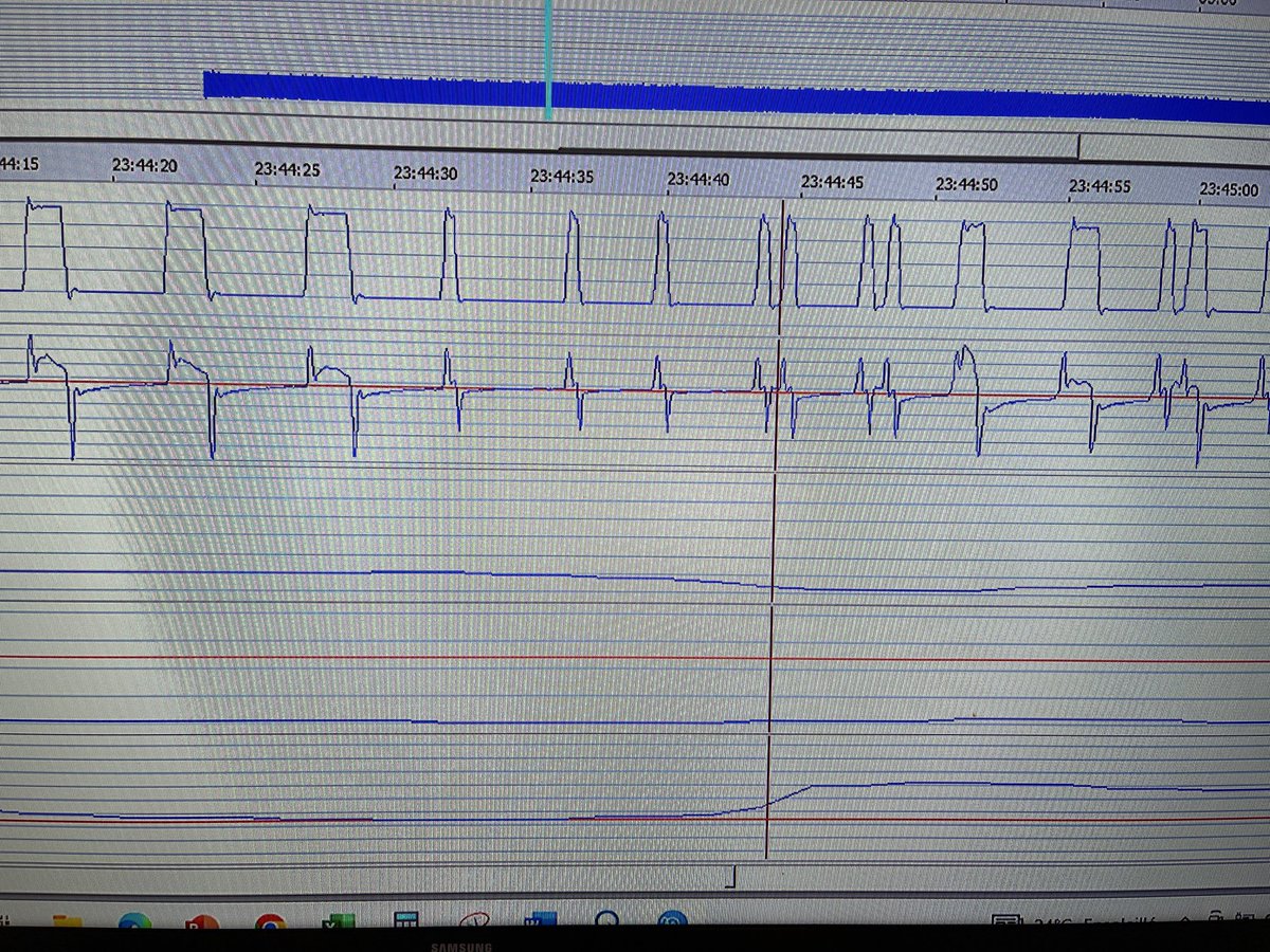 Autotriggering yes! but due to obstructions… (decrease of the flow). Here we just change the trigger that was very sensitive…few obstructions that we respect