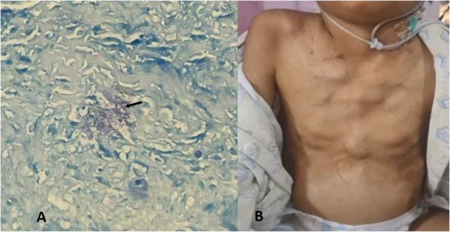A 7-YO child patient, from Peru: fever, cachexia & lymphadenopathy in the cervical & thoracic region,   with evidence of AARB in cervical lymph node biopsy.

Antituberculous treatment: partial clinical improvement
1/4

doi: 10.1016/j.idcr.2022.e01507
#IDtwitter #MedTwitter https://t.co/pgAyAYJFQE