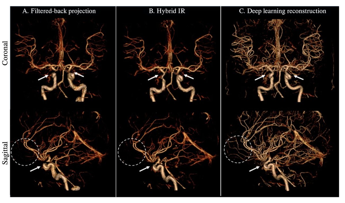 JINeuroscience's tweet image. #2021Issue4
The #DeepLearningReconstruction method generally improves the image quality of brain computed tomography angiography in terms of objective measurement and subjective grading
imrpress.com/journal/JIN/20…
#ComputedTomography #CT #imaging #BrainAngiography #IntracranialVesse