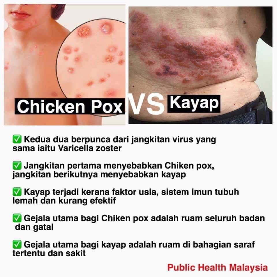 DoktorSamhan's tweet photo. “Pakcik datang hari ini sebab apa?”

“Doktor tolong pakcik, pakcik ada kayap ular. Kalau kayap ini bersambung, mati pakcik”, sambil selak bajunya.

“Pakcik pernah kena chicken pox masa kecil dulu?Atau ada orang panggil cacar air.Yang kulit jadi gelembung lepas itu jadi parut” https://t.co/PrR1ju2pqm