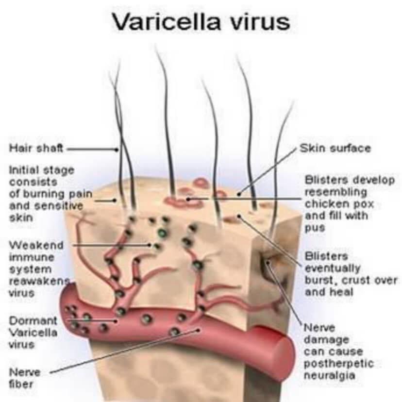 DoktorSamhan's tweet photo. “Pakcik datang hari ini sebab apa?”

“Doktor tolong pakcik, pakcik ada kayap ular. Kalau kayap ini bersambung, mati pakcik”, sambil selak bajunya.

“Pakcik pernah kena chicken pox masa kecil dulu?Atau ada orang panggil cacar air.Yang kulit jadi gelembung lepas itu jadi parut” https://t.co/PrR1ju2pqm