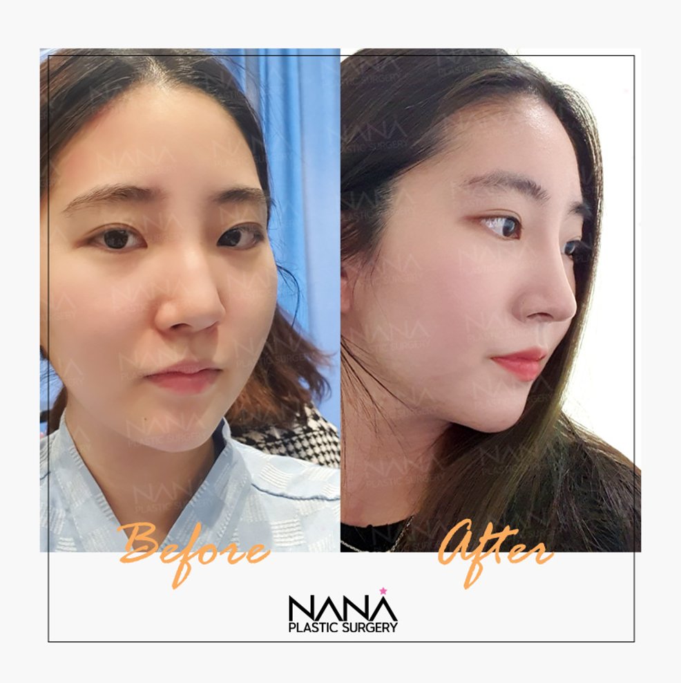 韓国整形 Nana美容外科 追加金なし 韓国在住者限定キャンペーン お早めにご連絡ください アメブロ 출처 Ameba Official 日韓夫婦 ソウル 韓国留学 日韓カップル By 韓国nana美容外科 Edayfm 韓国整形 Nana美容外科 追加金なし 韓国在住者限定キャンペーン お早めにご連絡ください アメブロ 출처 Ameba Official 日韓夫婦 ソウル 韓国留学 日韓カップル By 韓国nana美容外科 Edayfm