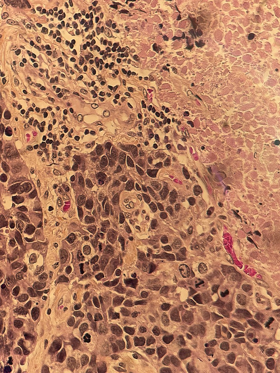 M7ammed_Subait's tweet photo. Male Pt 65 years with cerebellum tumor and pulmonary nodule that not been biopsy yet! What’s your dg? What is your IHC?! #neurotwitter #Neurosurgery #PathTwitter https://t.co/r5szsG8Oi1