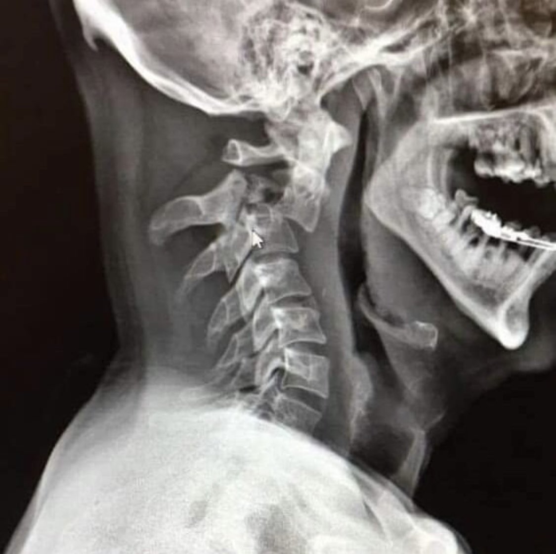 XrayProblems's tweet photo. Oops!
#xrayprobs #radiology #radtech #ctscan https://t.co/khzspTipq9