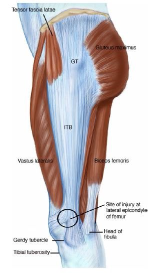 ITB issues don’t always have to be around the knee. This lady training for the London marathon presents with ITB traction and inflammation on the iliac crest insertion. 

Much broader insertion on ilium so not as common as the knee but similar principles apply to causes and Rx.