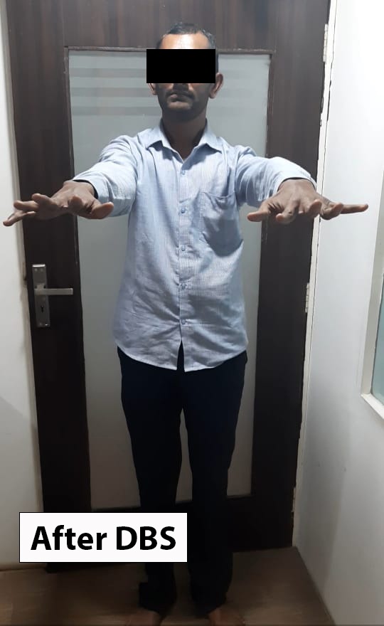 dr_cns's tweet photo. FIRST ever case of DBS for Dystonia in Gujarat. Happy to make difference to this young chap's life...#dbs #deepbrainstimulation #dystonia #brainpacemaker #movementdisorder #functionalneurosurgery #firstcase #Gujarat https://t.co/3g97qnGwQt