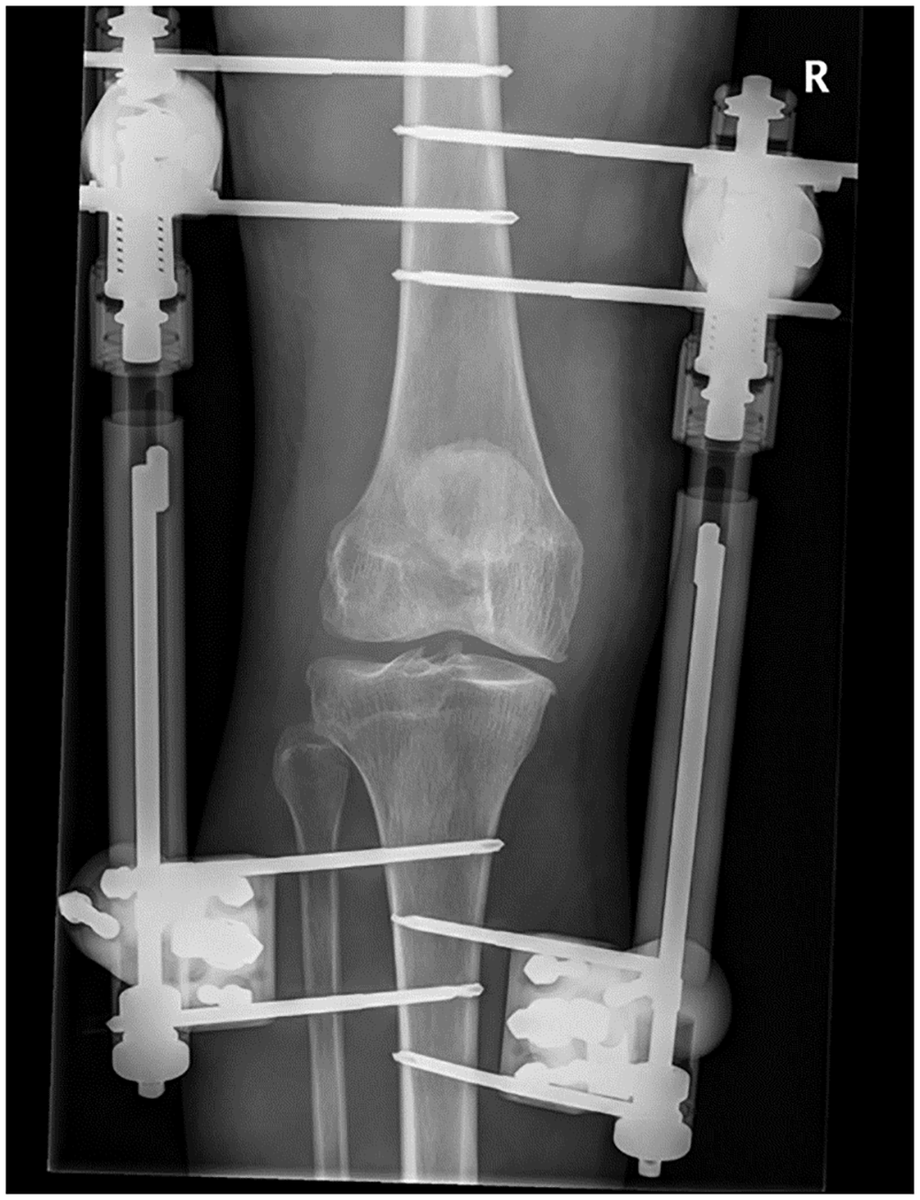 DrJustinAlbert1's tweet photo. Knee joint distraction in regular care for treatment of knee osteoarthritis https://t.co/FZYgVmKKhq
