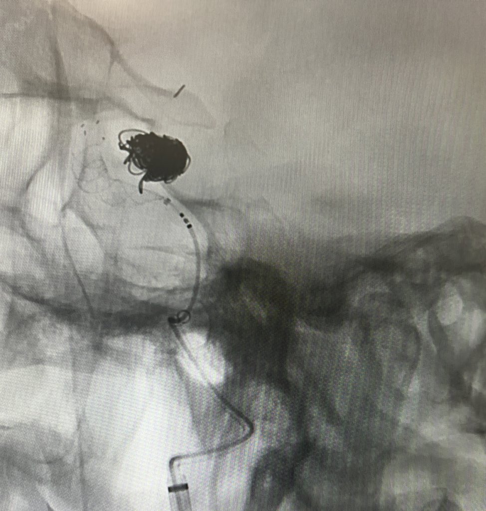 KenJohnsonMD's tweet photo. Initial #FREDX flow diverter experience, for this traumatic pseudo aneurysm. Simple deployment, great result, complete resolution! @MV_Terumo https://t.co/HqRWVWYNer