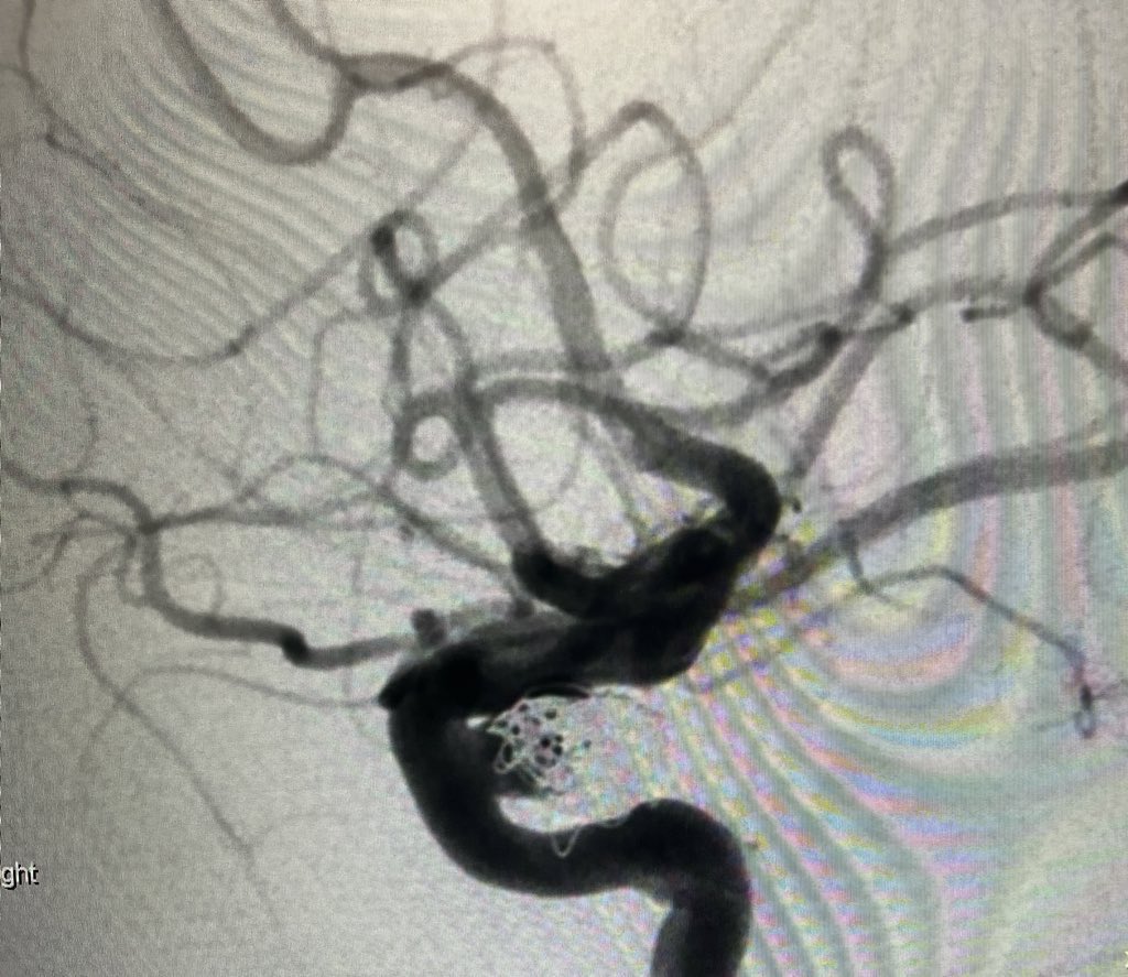KenJohnsonMD's tweet photo. Initial #FREDX flow diverter experience, for this traumatic pseudo aneurysm. Simple deployment, great result, complete resolution! @MV_Terumo https://t.co/HqRWVWYNer