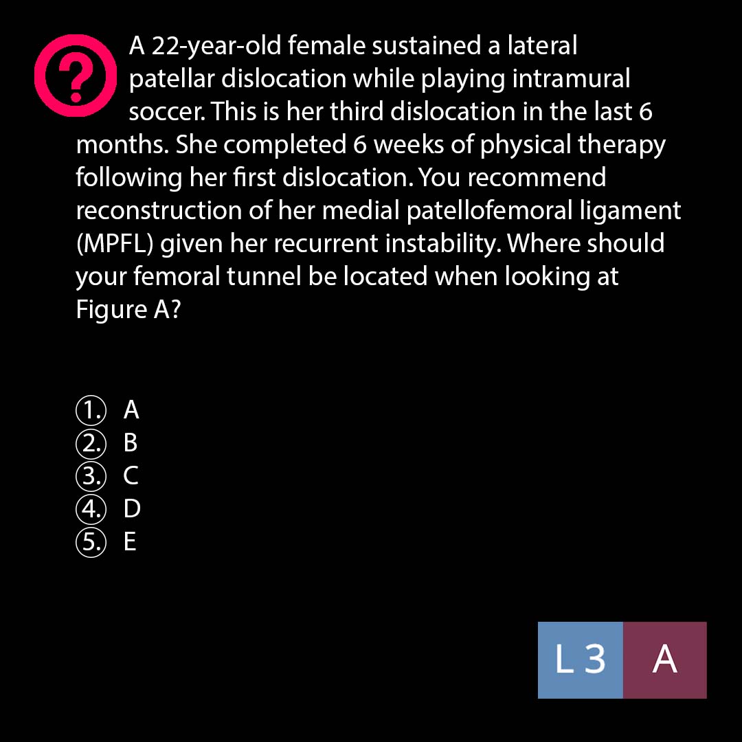orthobullets's tweet photo. Can you answer this daily question from our Free QBank correctly? 

QID: 214086
**The answer will be posted in 24 hours.
#orthotwitter #ortho #orthopedicsurgery #orthopedics #orthopedicsurgeon #orthopaedics #orthopaedic #orthopedic #ortholife  #orthoresident #MedTwitter https://t.co/VhaQt7TnlH