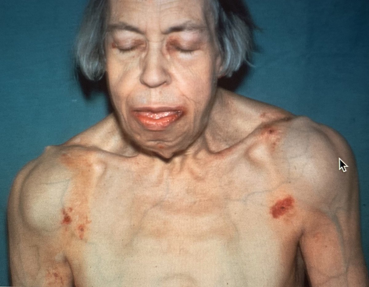 DrCassySims's tweet photo. One of the most memorable pictures in the @ACRheum image bank. Elderly woman presented with #macroglossia and 1 year later developed solid, firm masses of #amyloid on both shoulder (shoulder pad sign). #MedTwitter #Rheumtwitter https://t.co/Tpg4lt6OmD
