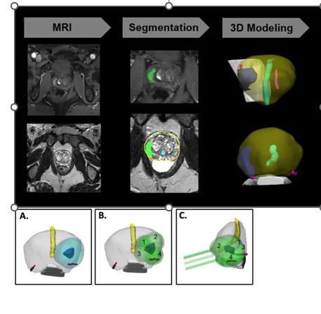 FrankRybicki's tweet photo. Terrific article in #3DPrintMed: study reports developing novel 3D procedure planning techniques to provide pre-ablation treatment planning for partial gland prostate cryoablation. Article: https://t.co/Z61BOU6noE @ClinMedJournals @BioMedCentral @SpringerNature @3DPrinting https://t.co/XJAlOM8gIF