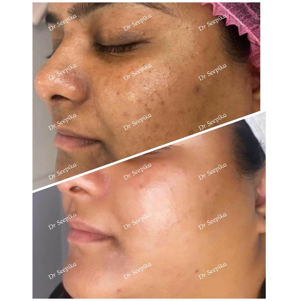 seepi20's tweet photo. Superb result with 4 sessions insta q switch laser and one session of customised cosmelan peel.
Kk hospital, opposite ssp office, qaiserbagh, lucknow between 11 to 1 Monday to Saturday 0522 2619049
#melasmatreatment #melasma #melasmasolution #lucknow https://t.co/xgrUrpL8N3