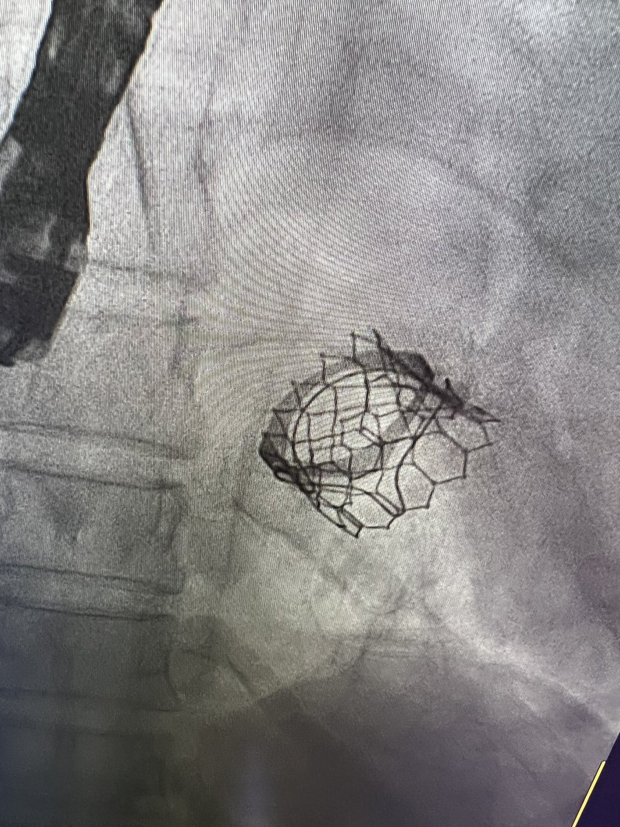 مريضتنا تعاني من كتمه شديده بالنفس ادت الى تقييد الحركه نتيجة تضيق صمام مايترال جراحي قبل عدة سنوات 

اصبح بالامكان الان العلاج عن طريق القسطره وتركيب صمام جديد 

كانت العمليه ناجحه ولله الحمد وتم خروج المريضه من المستشفى بدون اي اعراض ولله الحمد 

شكرا للفريق المشارك