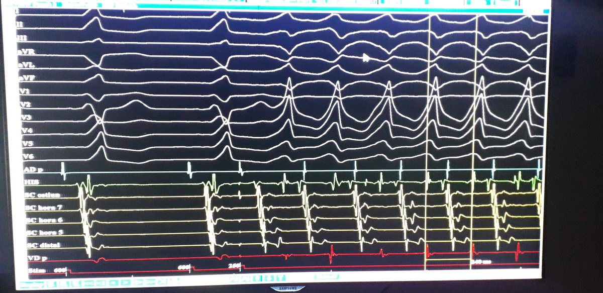 GusCostaEP's tweet photo. EP fellows: M 16 y/o
Patent prexcitation on surface ECG; atrial premature extraestimuli induced tachycardia. What is the mechanism??
Case done today at @hospitalposadas https://t.co/ch6V2PVKd1