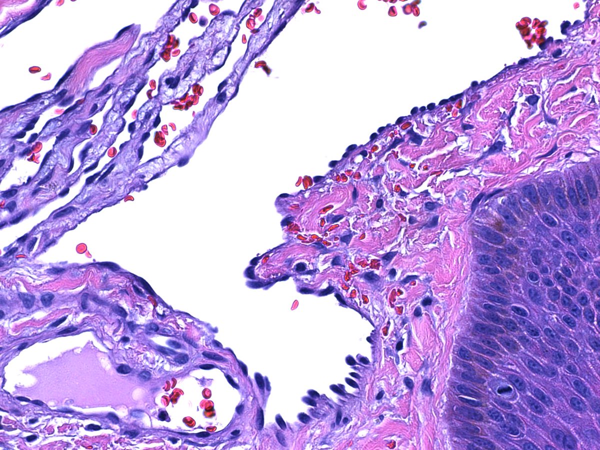 TexPathol's tweet photo. Case 1: Targetoid hemosiderotic hemangioma. Rare, benign vascular proliferation demonstrating hobnailed endothelial cells protruding into vessel lumina. Typically presents as a pigmented lesion on the lower extremities. Also known as hobnail hemangioma. https://t.co/SUlRLi2eXy