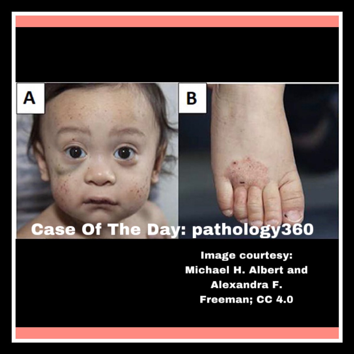 IG_pathology360's tweet photo. #CaseOfTheDay : for full case description, please follow the link : https://t.co/qyQiuskJmh #pathology360 #DrKishoreBanerjee #MedEdu https://t.co/x6ofDdX38R