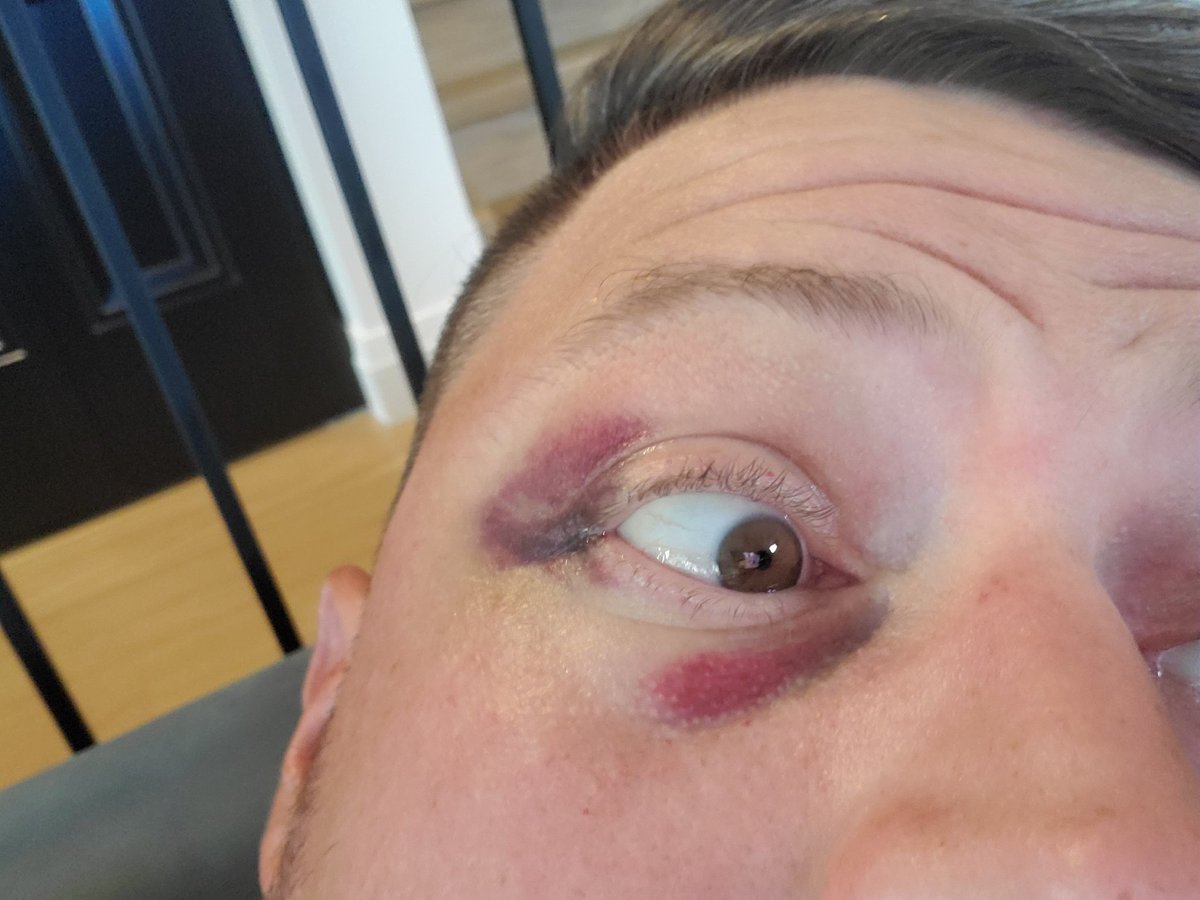 Canukian's tweet photo. Thanks again @Nike @nike_ca the bruising is still coming in, but wayyyyy less damage to my head then their could have been. The Swoosh saved me. #nike #swoosh #balltothehead https://t.co/qRxF9unXh0