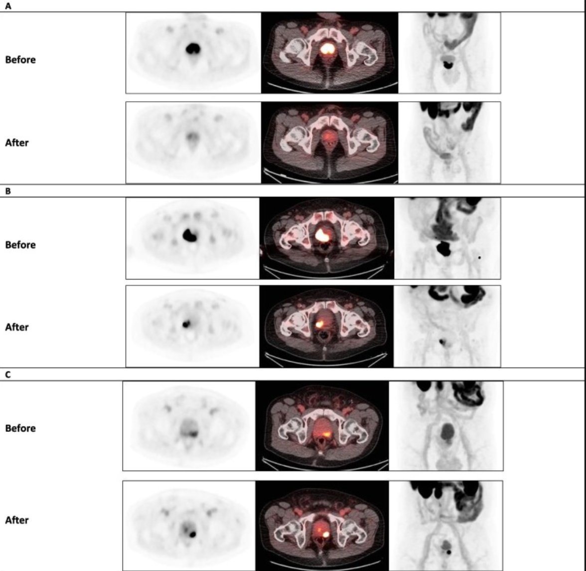 European Urology (@euplatinum) on Twitter photo ARNEO: A Randomized Phase II Trial of Neoadjuvant Degarelix with or Without Apalutamide Prior to Radical Prostatectomy for High-risk Prostate Cancer
buff.ly/3dMB7rB
<a href="/devos_gaetan/">Gaëtan Devos</a> <a href="/joniau/">steven joniau</a> <a href="/HendrikPoppel/">Van Poppel Hendrik</a> <a href="/GertMeerleer/">Gert De Meerleer</a> ARNEO: A Randomized Phase II Trial of Neoadjuvant Degarelix with or Without Apalutamide Prior to Radical Prostatectomy for High-risk Prostate Cancer
buff.ly/3dMB7rB
<a href="/devos_gaetan/">Gaëtan Devos</a> <a href="/joniau/">steven joniau</a> <a href="/HendrikPoppel/">Van Poppel Hendrik</a> <a href="/GertMeerleer/">Gert De Meerleer</a>