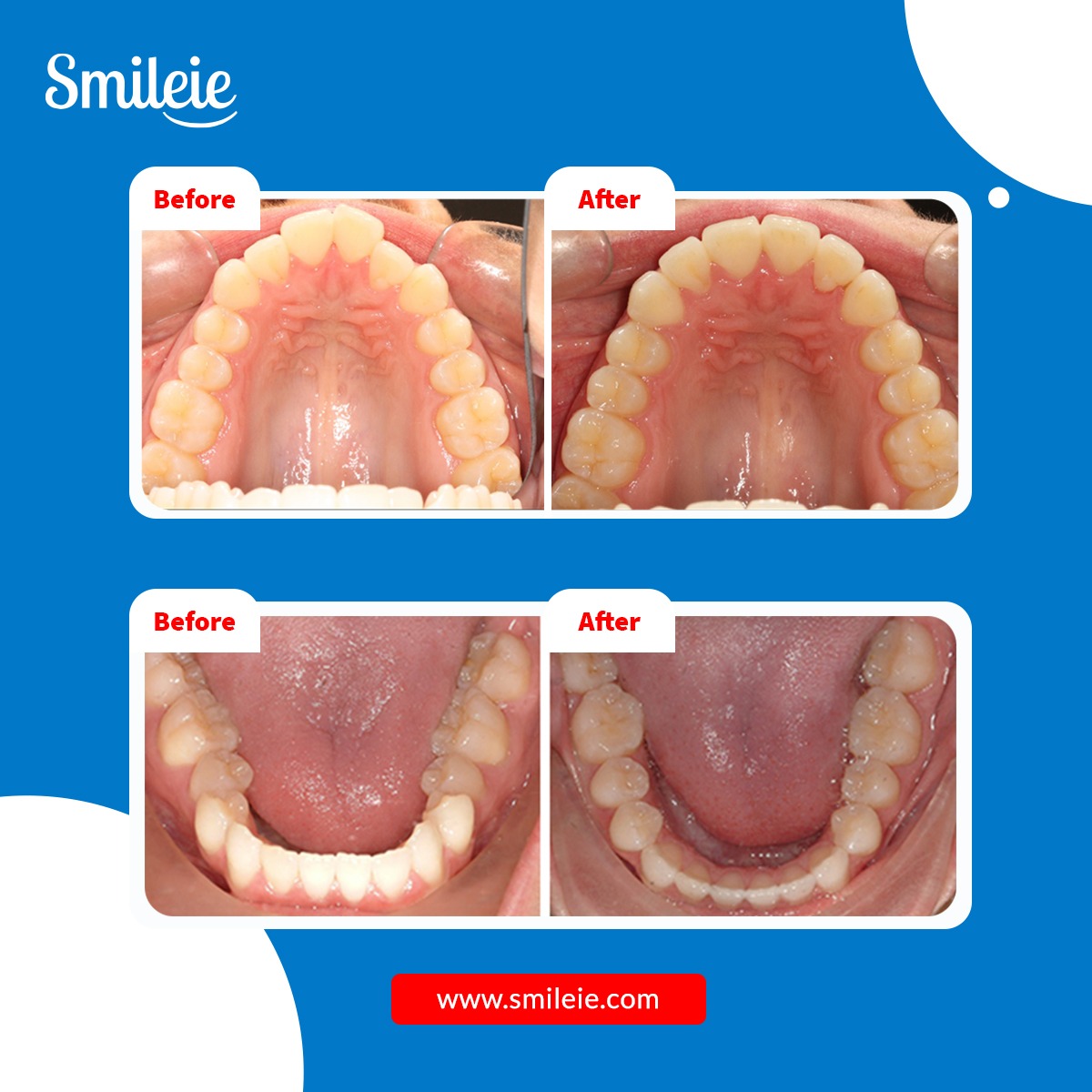 Smileie_'s tweet image. Fix underbites and overbites with Smileie clear aligners.

Check out your smile projection before you make the full Payment for your Aligners at just $̶7̶9̶.̶0̶0̶ $39 now👇
smileie.com/products/impre…

#Smileie #ImpressionKit #underbite #overbite #smiletransformation #beforeandafter