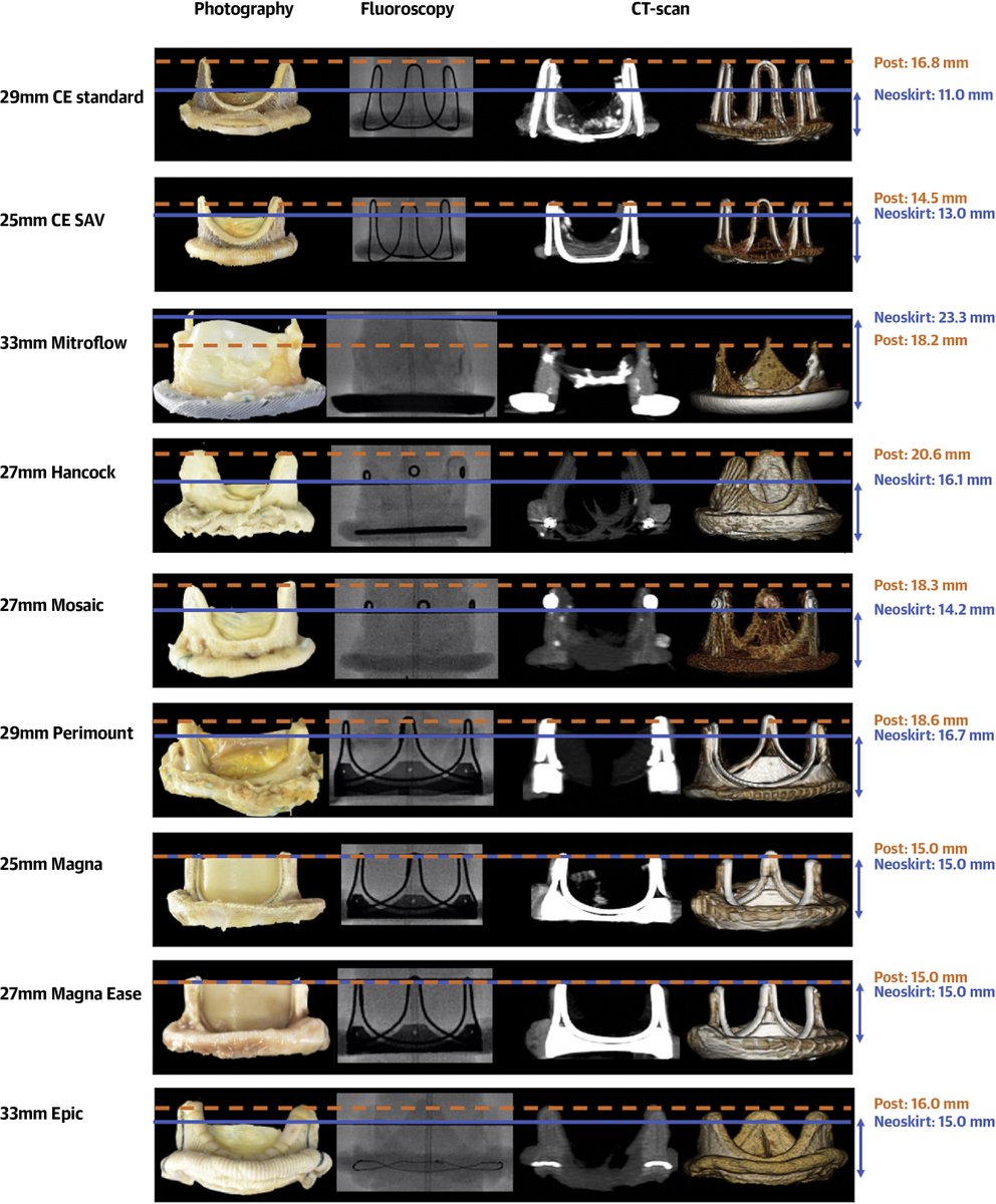 JACCJournals's tweet photo. Avoiding #LVOT obstruction following mitral valve-in-valve? This #JACCIMG #iPix shows how multimodality imaging assesses key differences in neoskirt height between different types of bioprosthetic mitral valves to aid preprocedural planning. https://t.co/F0mi3OqOUE #CardioTwitter https://t.co/f1WSvNDmAu