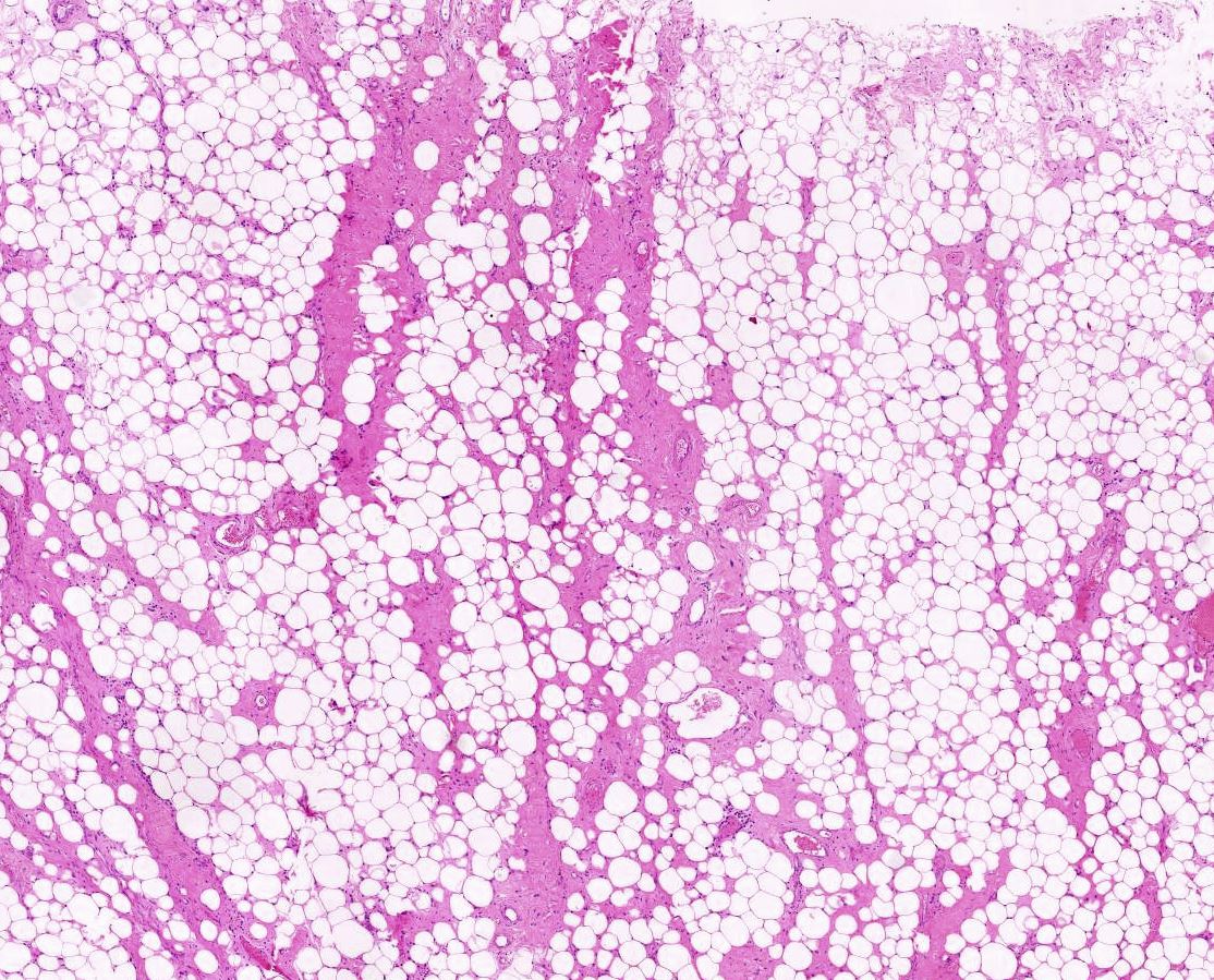 dr_amenona's tweet photo. Here's my attempt at a tweetorial on de-mystifyig a molecular entity. Shall we go? 

Recurrent mass in proximal thigh of a middle-aged man. https://t.co/Y4PbIvltrI