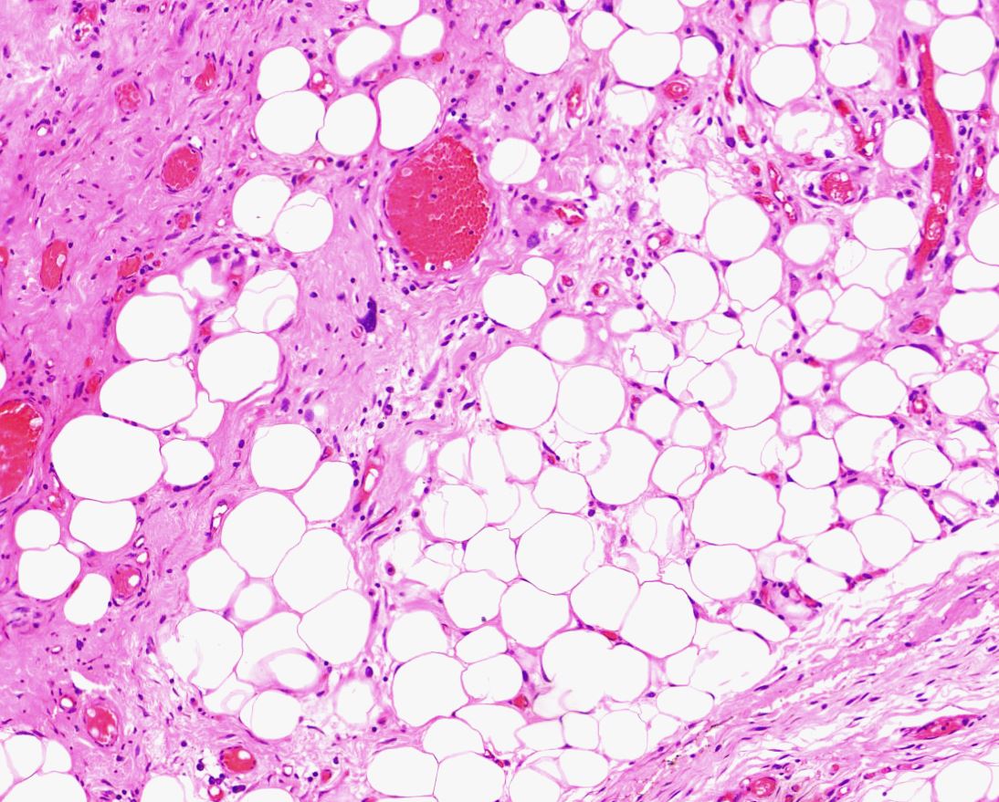 dr_amenona's tweet photo. Here's my attempt at a tweetorial on de-mystifyig a molecular entity. Shall we go? 

Recurrent mass in proximal thigh of a middle-aged man. https://t.co/Y4PbIvltrI