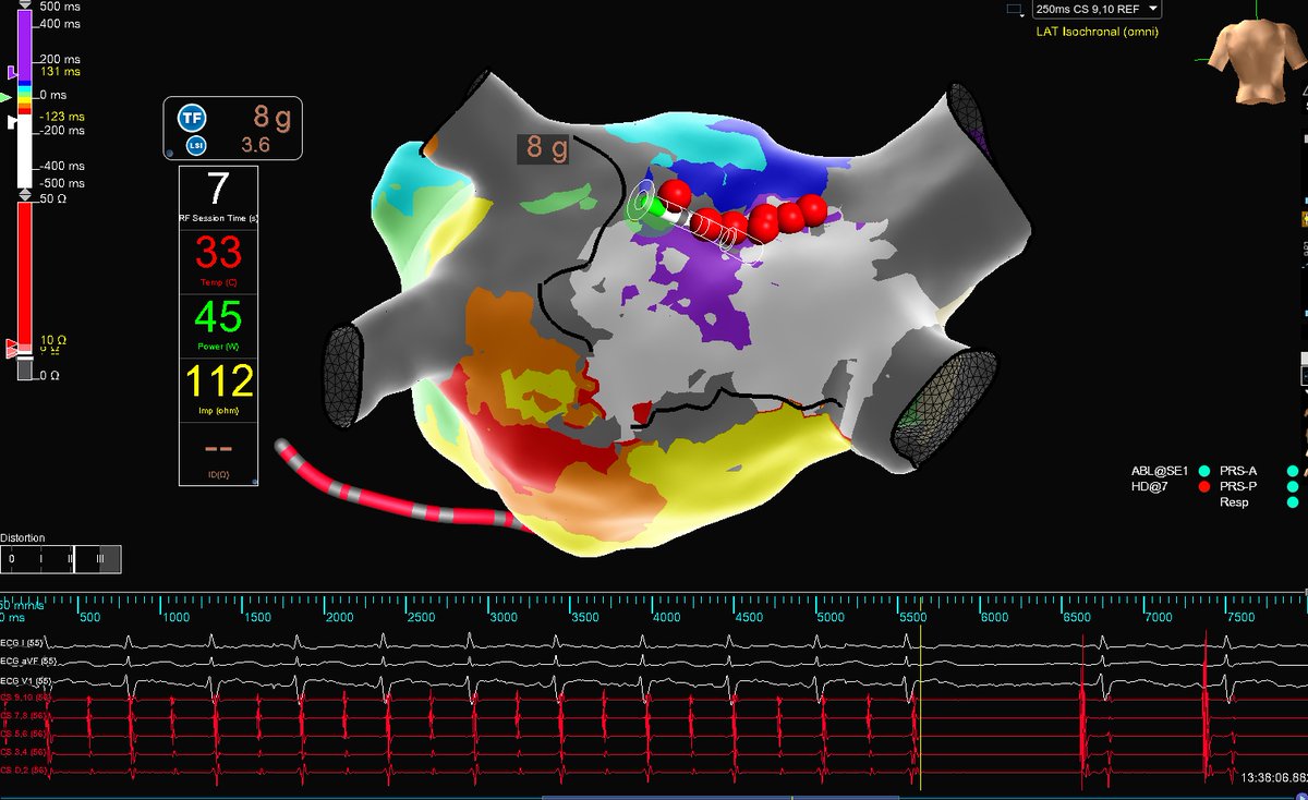 #OnlywithOT map of LA AFL showing breakthrough on roof. Nice termination with completion of roof line. Area of conduction slowing on post wall adjacent to LIPV overlying esophagus and not ablated. #HDGrid #EPeeps @pranav_mankad @KennethEllenbo1