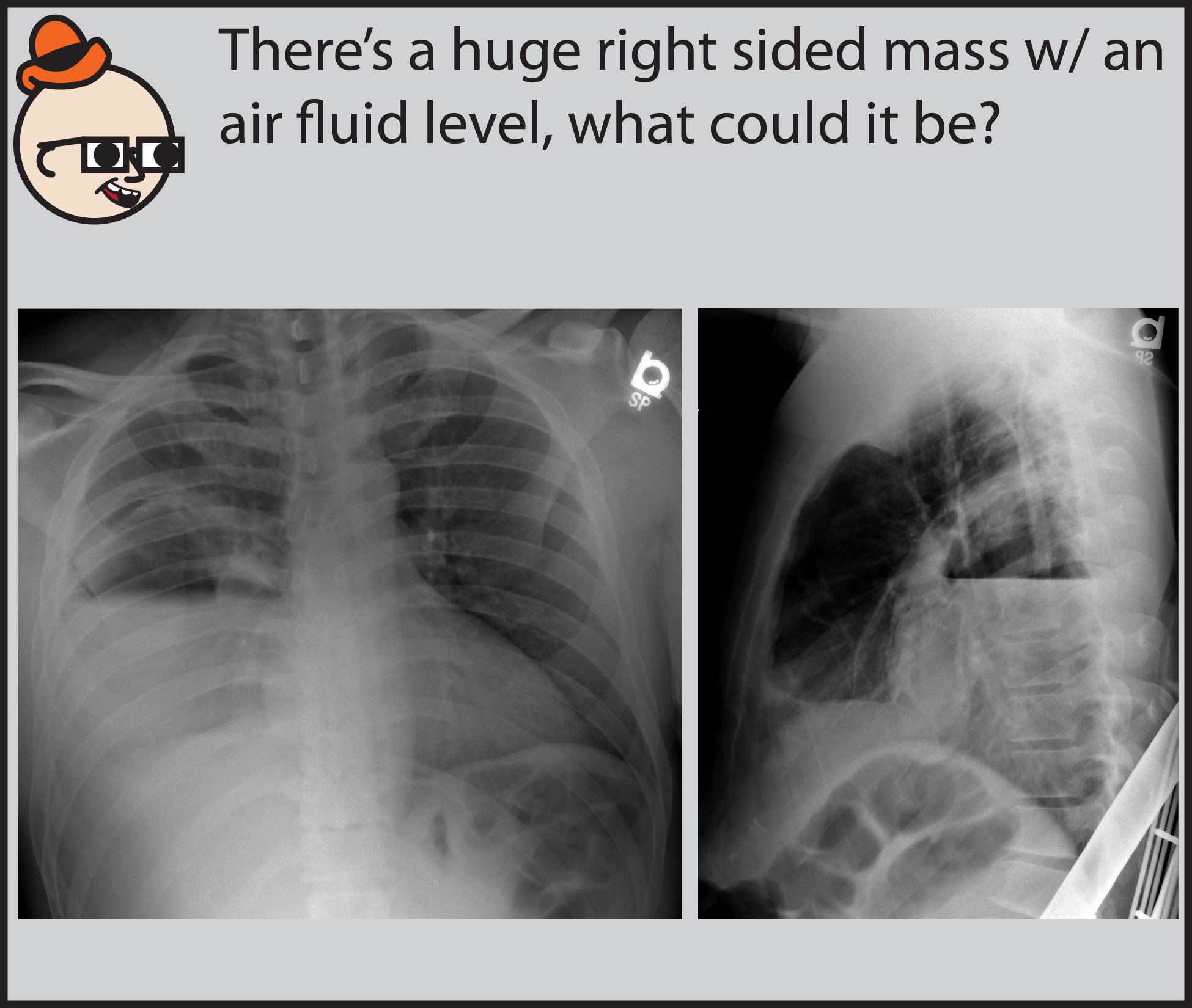 Lung Abscess X Ray Stock Image C0187139 Science Photo vrogue.co