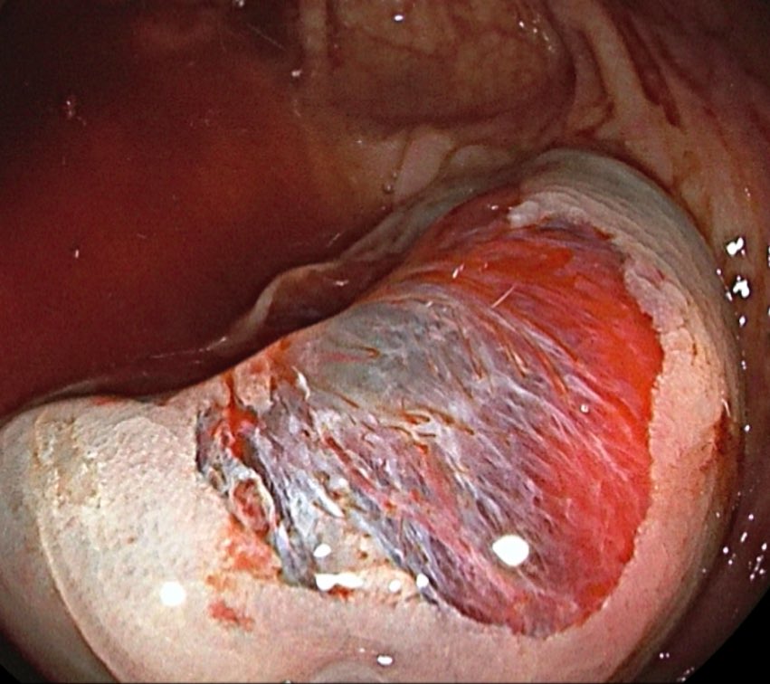 JJFordeMD's tweet photo. Cold is the new hot! 🥶 Cold EMR of a 30 mm Paris 2a LST of the ascending colon.  #GITwitter https://t.co/N2RPhwS4MM