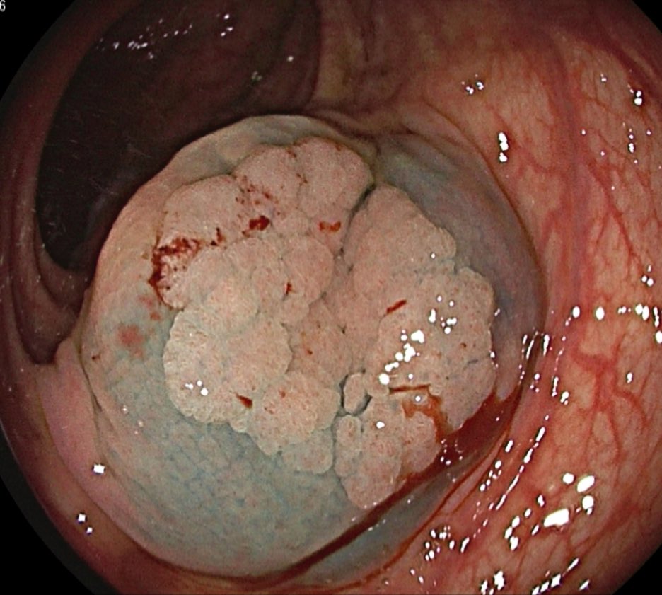 JJFordeMD's tweet photo. Cold is the new hot! 🥶 Cold EMR of a 30 mm Paris 2a LST of the ascending colon.  #GITwitter https://t.co/N2RPhwS4MM