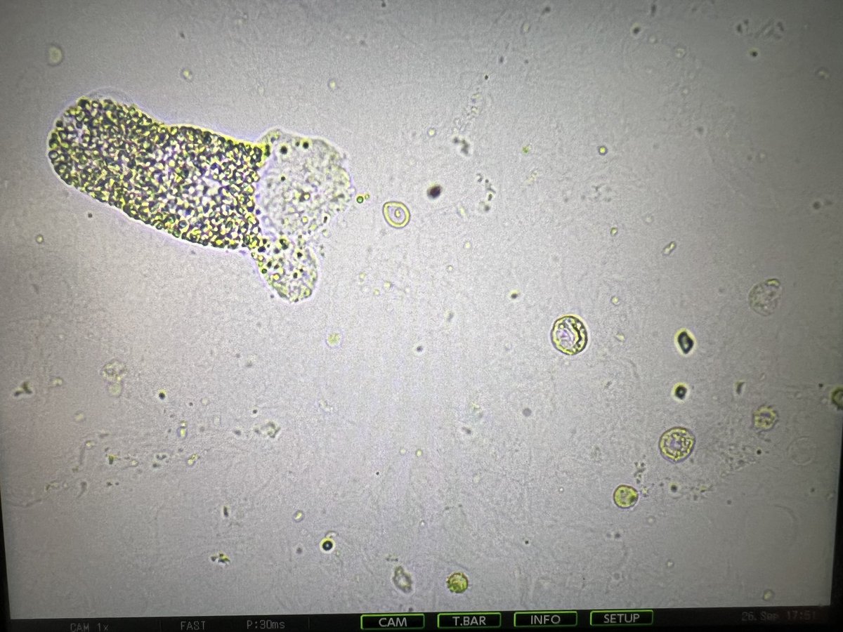 msc271's tweet photo. 56AAM w/PMH ESRD due to FSGS s/p DBD KT in 2018 c/b Banff 1A ACR, HTN, HFpEF, HIV who presented c/o worsening LE edema and found to have nephrotic syndrome and AKI of allograft kidney. #UrinarySediment #UrineMicroscopy #acanthocytes https://t.co/6eN3vrY4GA