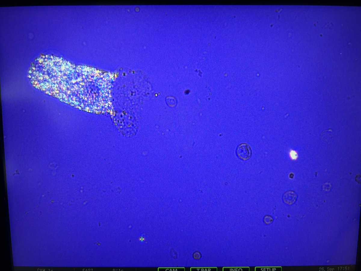 msc271's tweet photo. 56AAM w/PMH ESRD due to FSGS s/p DBD KT in 2018 c/b Banff 1A ACR, HTN, HFpEF, HIV who presented c/o worsening LE edema and found to have nephrotic syndrome and AKI of allograft kidney. #UrinarySediment #UrineMicroscopy #acanthocytes https://t.co/6eN3vrY4GA