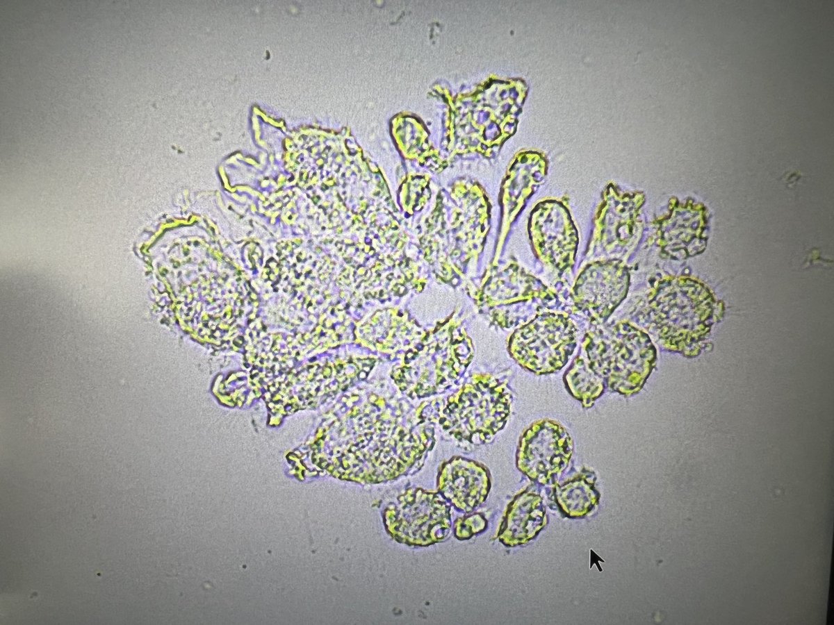 msc271's tweet photo. 56AAM w/PMH ESRD due to FSGS s/p DBD KT in 2018 c/b Banff 1A ACR, HTN, HFpEF, HIV who presented c/o worsening LE edema and found to have nephrotic syndrome and AKI of allograft kidney. #UrinarySediment #UrineMicroscopy #acanthocytes https://t.co/6eN3vrY4GA