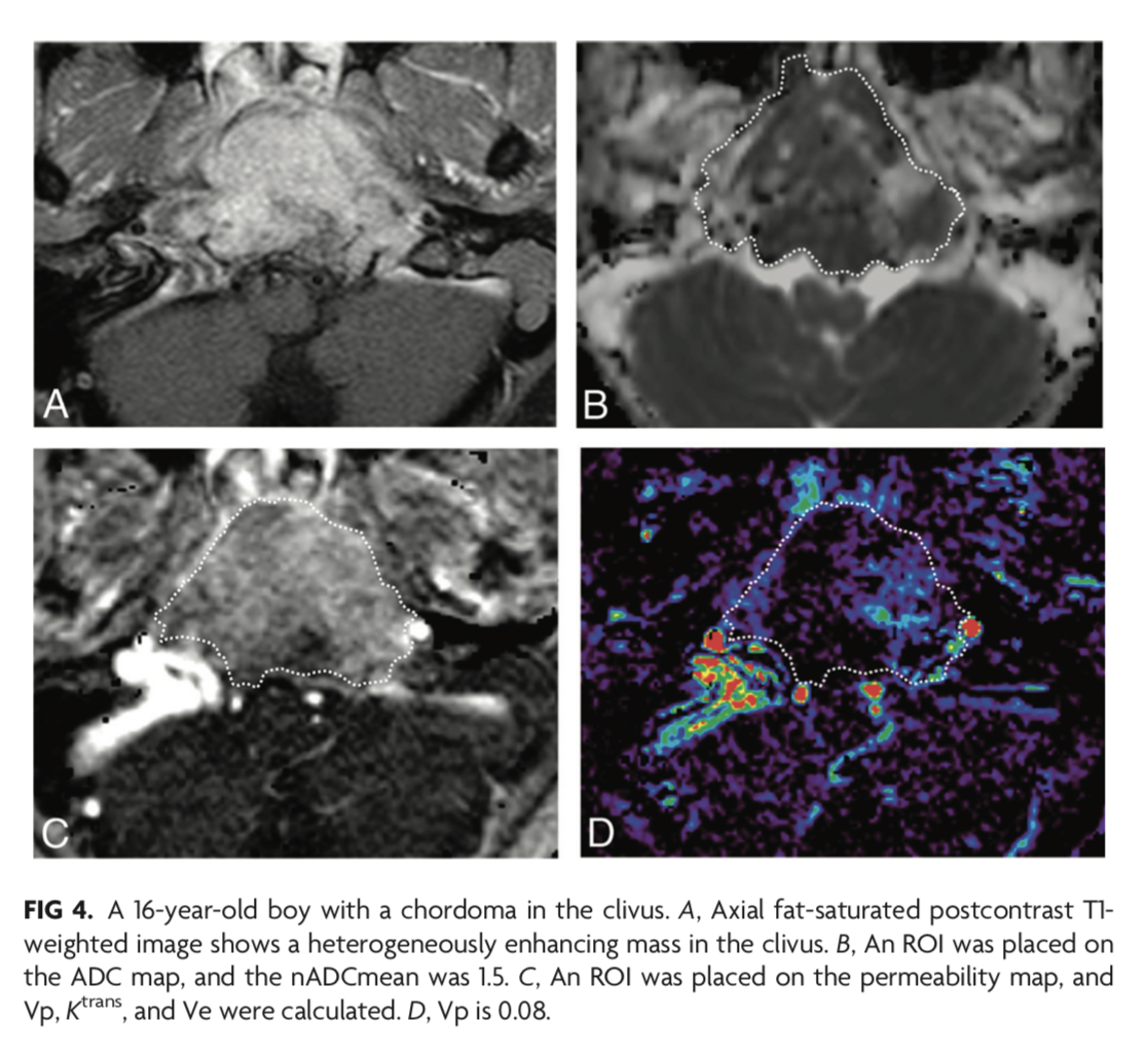 TheAJNR's tweet photo. “Differentiation of Skull Base Chondrosarcomas, Chordomas, and Metastases: Utility of DWI and Dynamic Contrast-Enhanced Perfusion MR Imaging” #Skullbase #DWI #DCE #OpenAccess @GattsukiRadiol @ASHNRSociety   | https://t.co/FLstmUxTzp https://t.co/JUibaFarw7