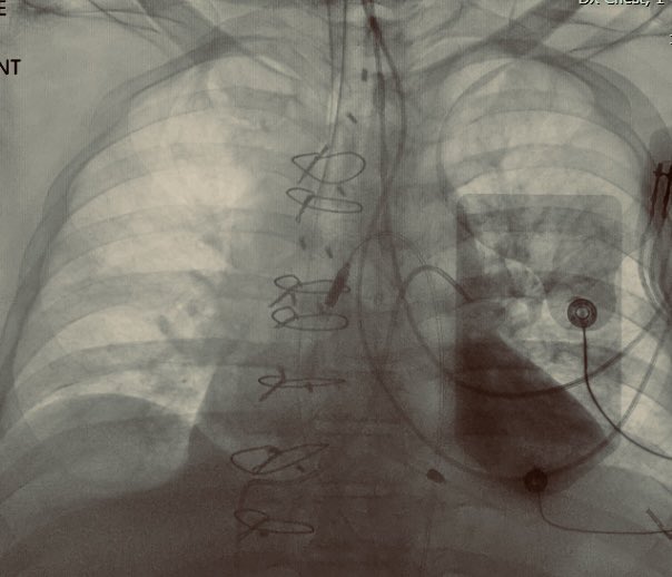 [1] A "wandering" PA catheter

A pt with acute on chronic HFrEF (decline d/t acute ant wall MI) was...