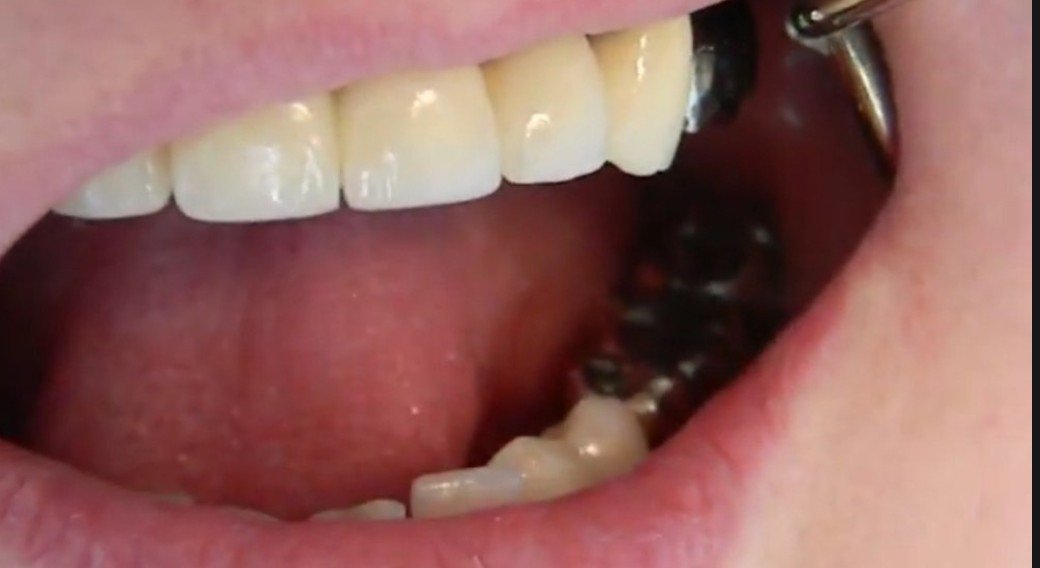 Gold and Silver Teeth Lover on Twitter "https//t.co/qLwbyhijZf" / Twitter