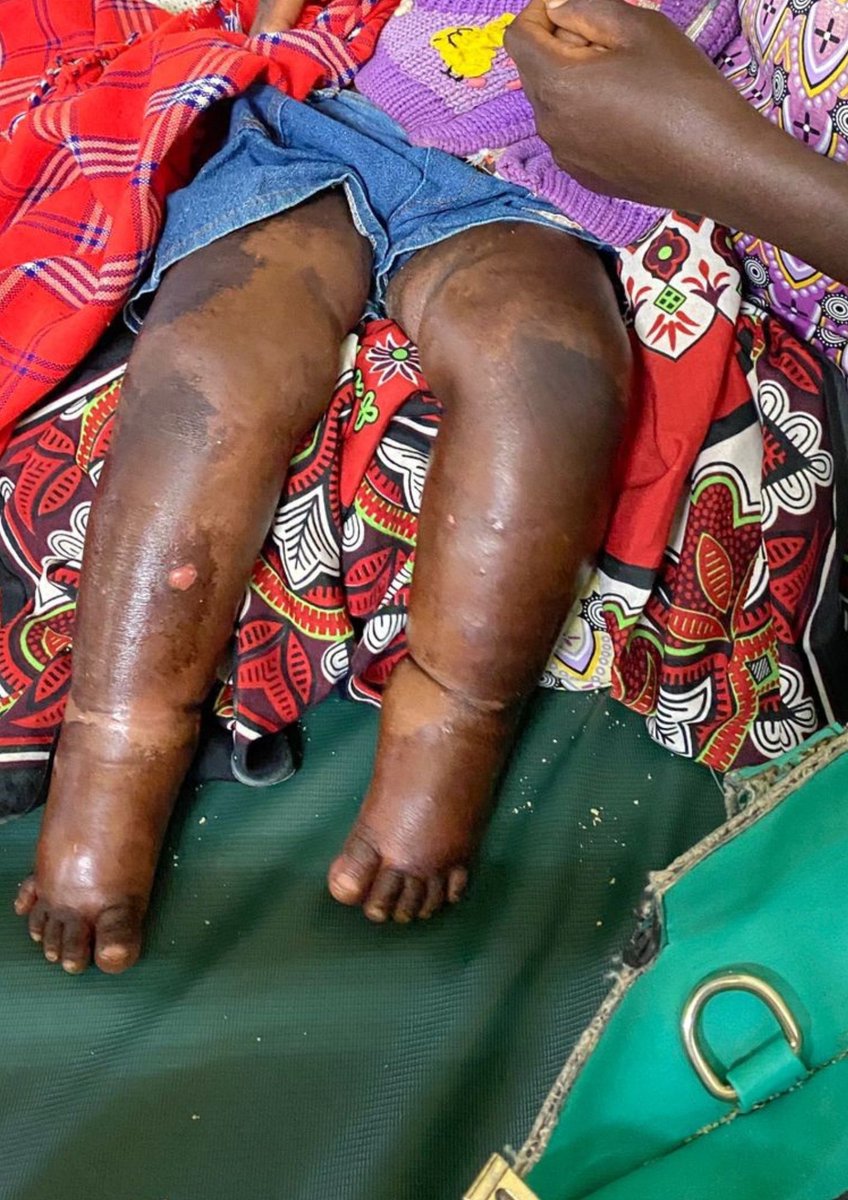 Kwashiorkor
This is a form of severe acute malnutrition that presents with oedema that starts from the dependent positions and progresses cranially. There is marked muscle atrophy with normal or even increased body fat.