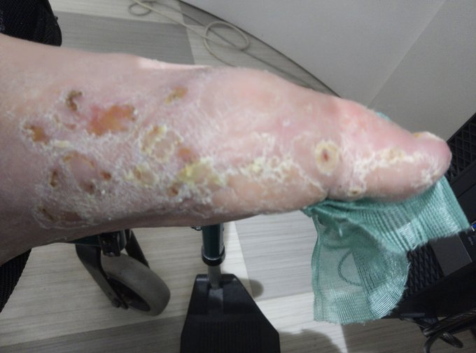 MarcoSaarikko's tweet photo. Kyllä rokote kannattaa ottaa. Fiilis on huikea ja jalat kunnossa. Vittu kun noita revitään joka päivä auki ja 4 antibioottia painetaan suoneen ennen terveelle miehelle niin voinette kuvitella mikä on tunne tila.. https://t.co/ZtoSTrdw6X