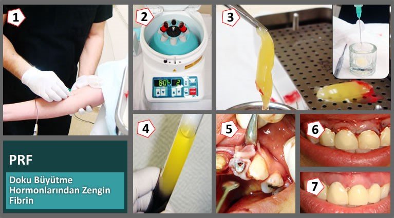 Daha Çabuk İyileşme (PRF)
Kök hücreler vücudumuzdaki tüm organları ve dokuları oluştururlar.
#prf #dahaçabukiyileşme #implant #implantdiş #implantdiştedavisi #implantdişhekimi #ömerkutay
omerkutay.com/daha-cabuk-iyi…