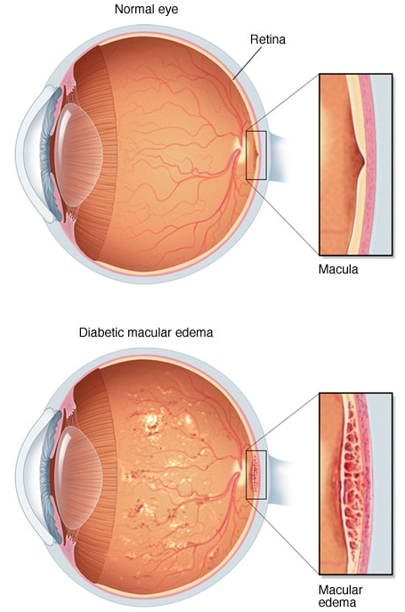 endocrinol1's tweet photo. Diabetic macular edema, can cause vision problems or blindness. It occurs when tiny bulges protrude from the vessel walls, leaking or oozing fluid and blood into the retina.
#macularedema #diabeticemacularedema #visionproblem #blindness #leakingofblood https://t.co/njsVLo0S5j